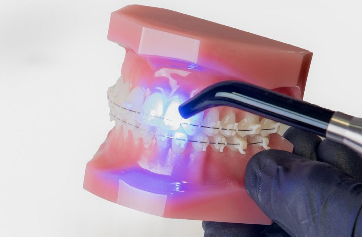 Kiểm nghiệm khí cụ chỉnh nha in 3D